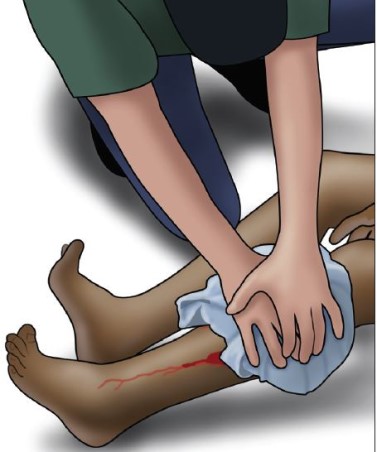 An illustration of pressure being applied to a wound to stop the bleeding.
