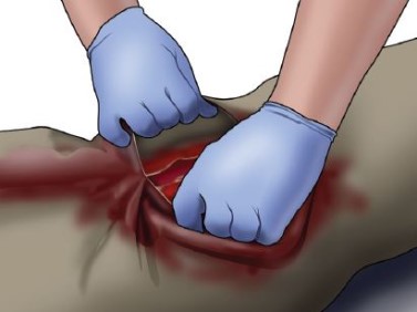An illustration of someone looking for the source of bleeding.