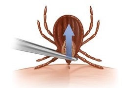 An illustration of tweezers removing a brown 8-legged tick from skin.