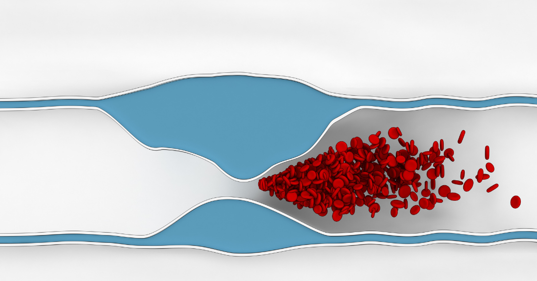 Atherosclerosis disease - plague blocking blood flow.